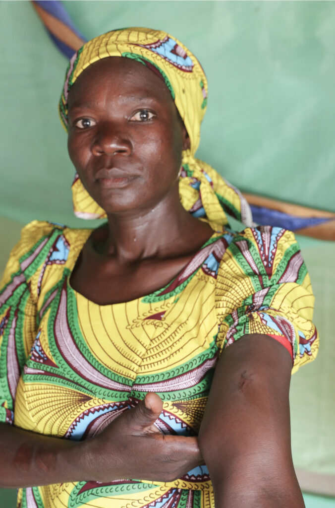 A woman shows her scars from a bullet