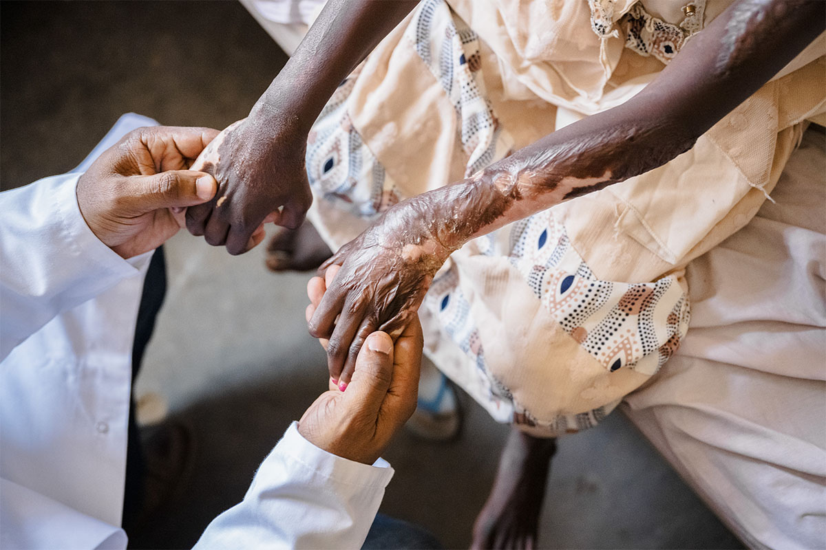 Holding hands with a burn wound victim