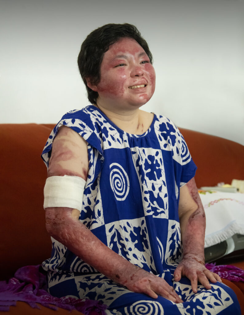 Fenny is pictured with the scars on her face, arms, and hands in view.