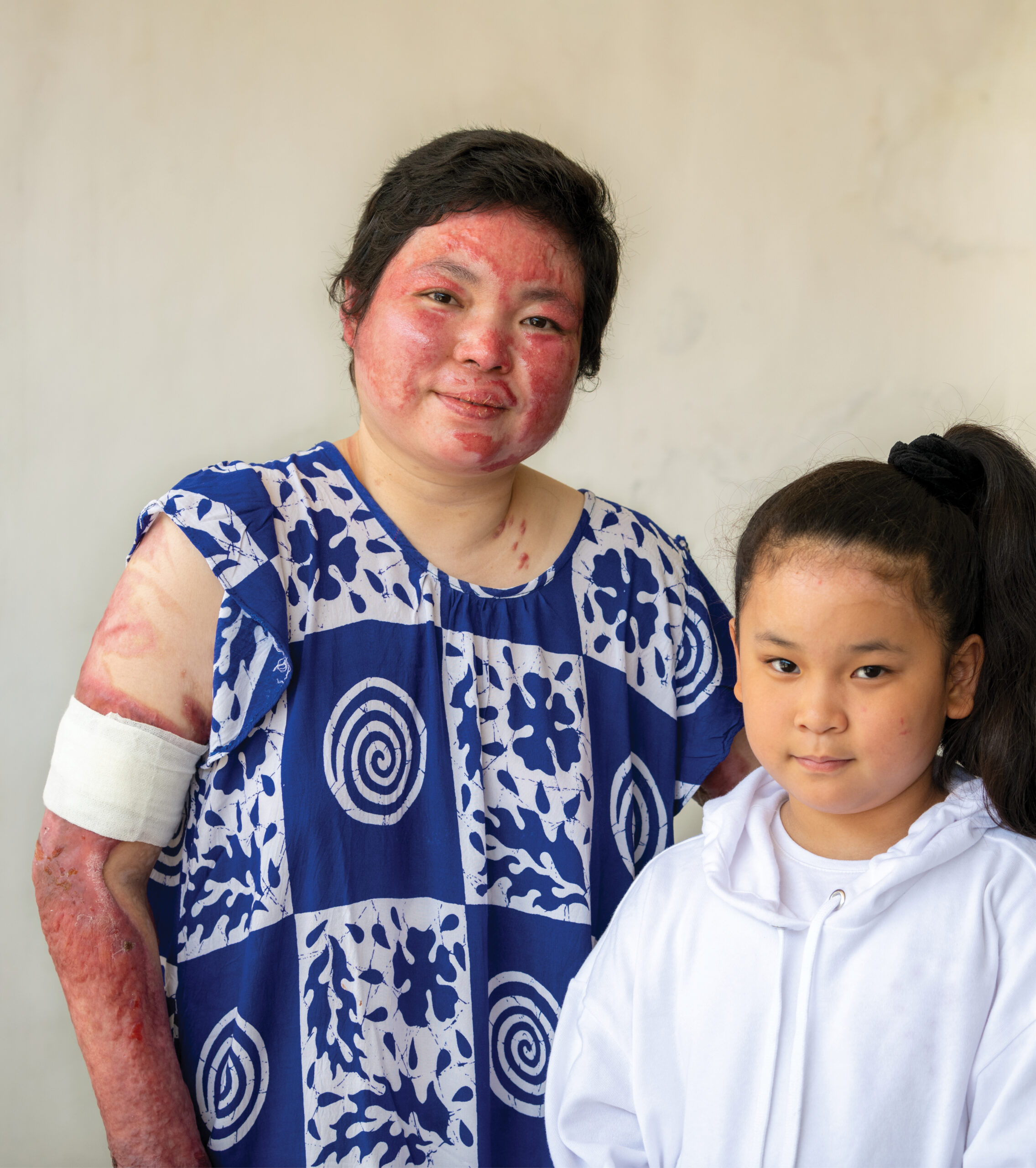 two female bombing survivors standing together