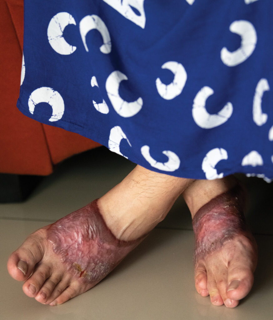 Burned feet of woman injured in Indonesian church bombings